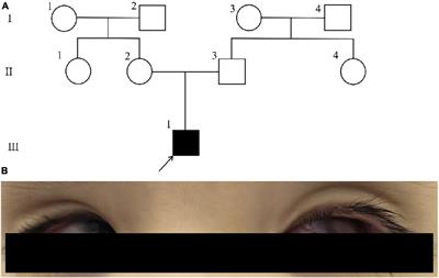 Case report: Genetic diagnoses in a pediatric patient with retinoblastoma and comorbid global developmental delay: three distinct entities diagnosed by whole exome sequencing in a single patient